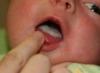 Effective ways to treat stomatitis in children: what to do if a child has a sore mouth?